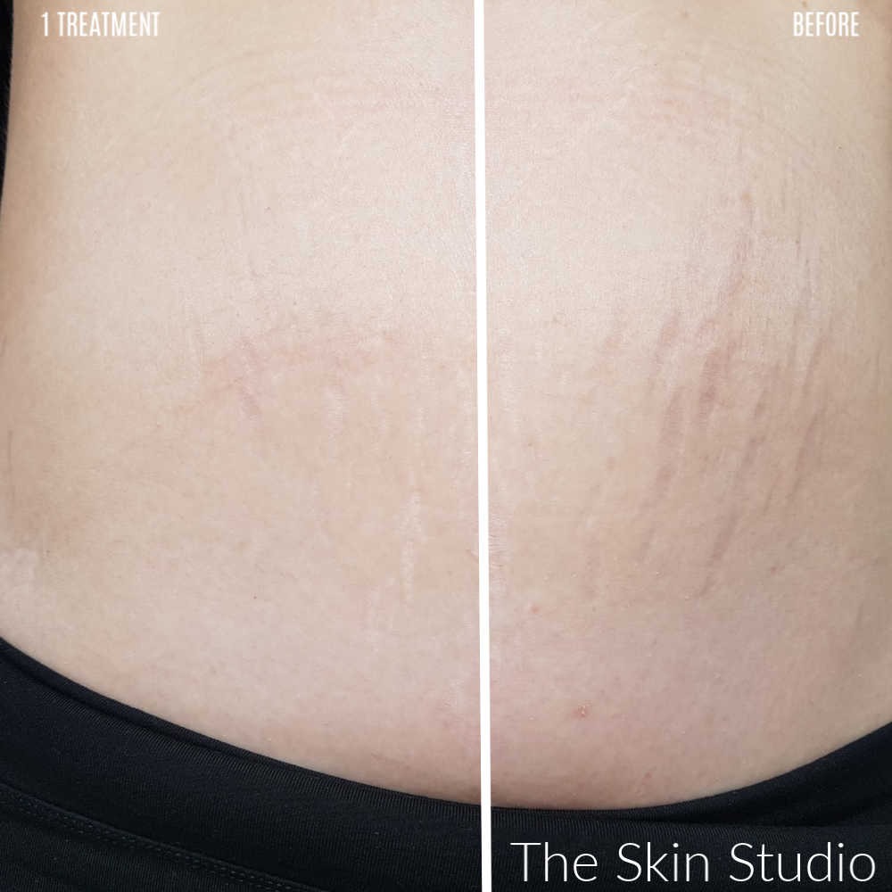 Anti Stretch Mark Cream